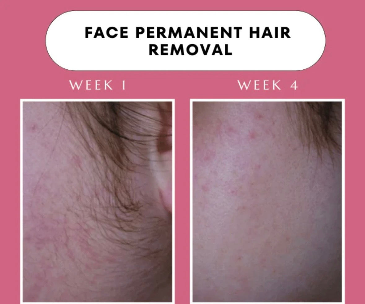 Elitezza IPL Pro - Laser Hair Removal Device